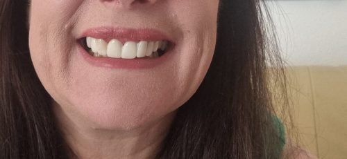 StoreTom Unisex Snap-On Veneers  | Natural Look | Instant Smile | BPA-Free| 1 pair (Uper and lower) photo review